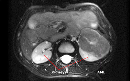 Kidney ultrasound image showing an AML