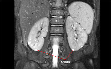 Kidney ultrasound image showing cysts