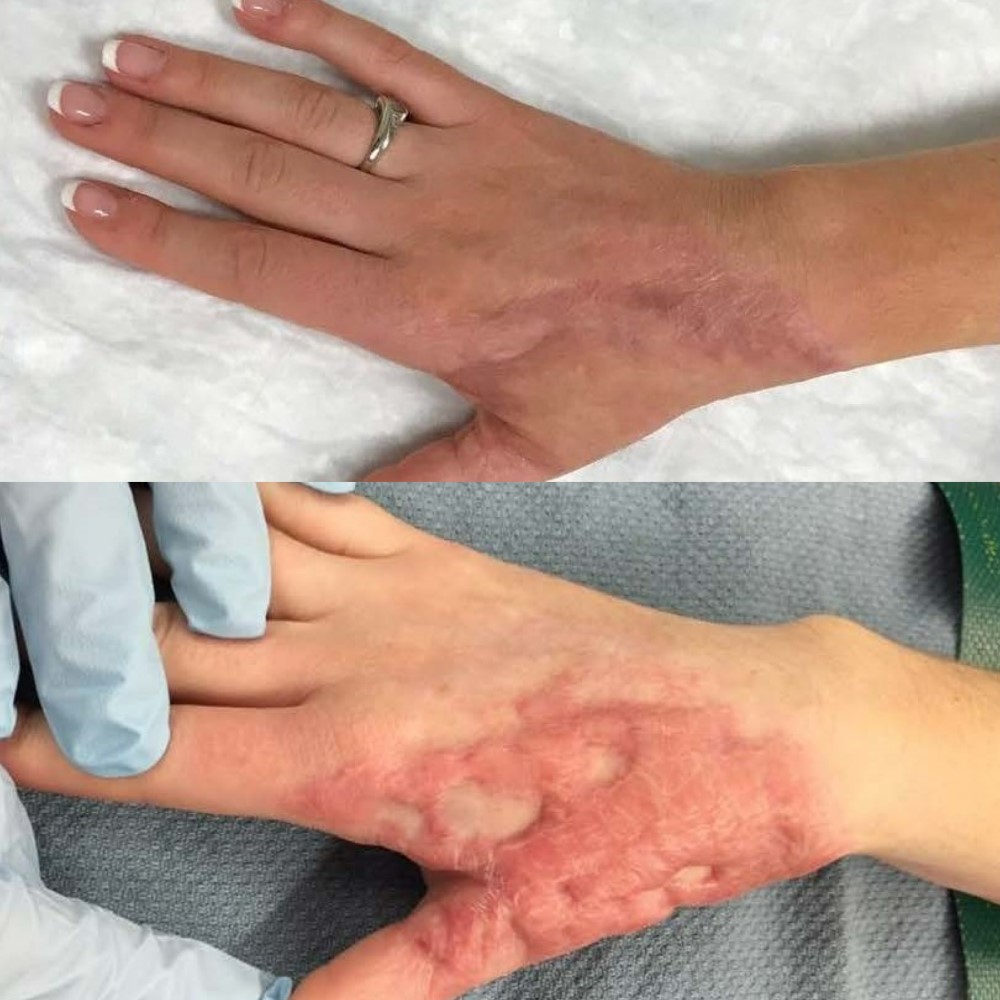 Before and after photos of a hand with severe burn scars.