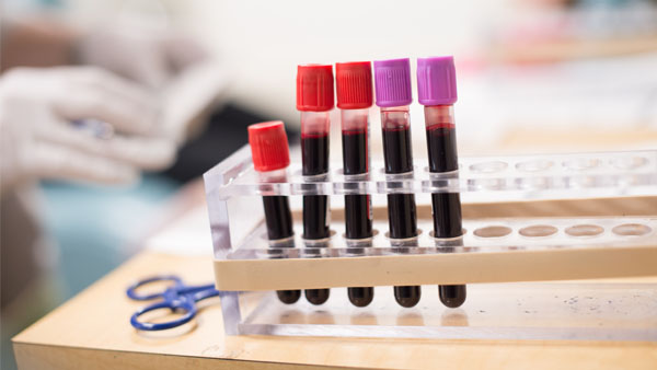 Vials of blood on a counter