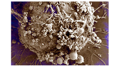 Extracellular Vesicles in Brain Cancer Blood Testing - November 2018 Advances article