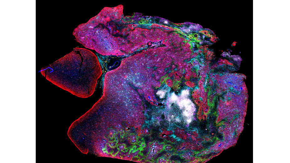 Highly multiplexed spatial proteomic profiling (CODEX) of a CAR-T cell treated patient tumor specimen. Highly multiplexed spatial proteomic profiling (CODEX) of a CAR-T cell treated patient tumor specimen.