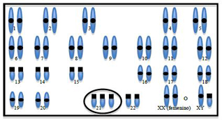 Chromosome array of trisomy 21