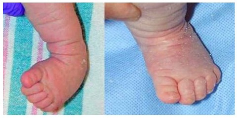 A baby's foot before and after treatment for clubfoot.
