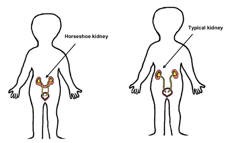diagram of horseshoe kidney