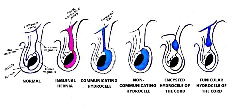 Different types of hydrocele