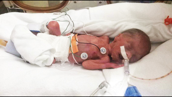 Penny Clark in the NICU at 26 weeks premature