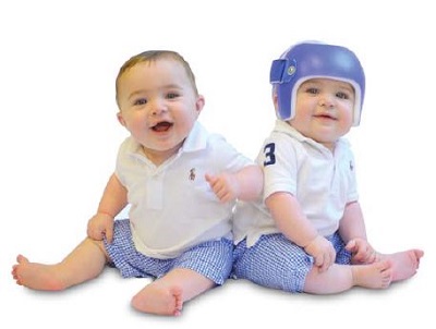 Two babies, one with plagiocephaly wearing a helmet and one without plagiocephaly, not wearing a helmet