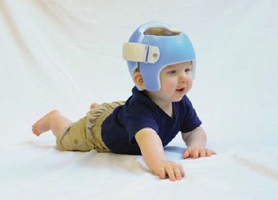 Baby wearing a positional head shape molding helmet for plagiocephaly