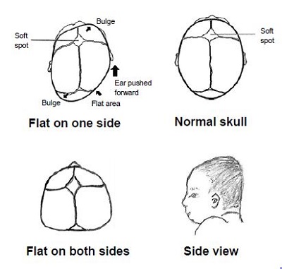 Diagram of baby's head shape with plagiocephaly