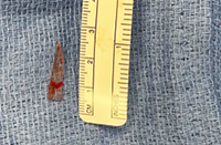 The piece of glass removed from Alaina's chest laying next to a tape measure to show the size. 