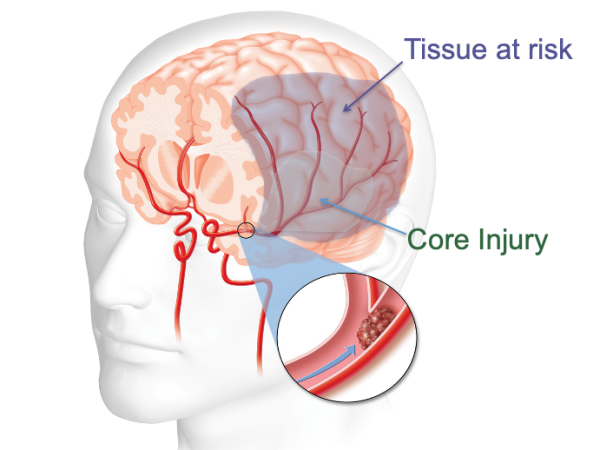 Diagram of arterial ischemic stroke