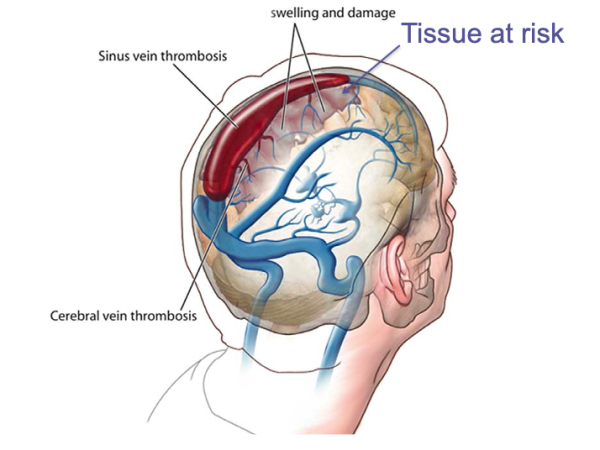 Diagram of venous thrombosis