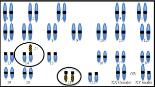 Diagram of the chromosomal pairs in translocation Down syndrome.