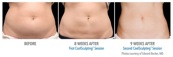  coolsculpting female stomach