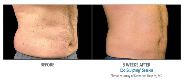  coolsculpting male stomach