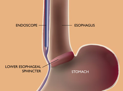 Diagram of the esophagus and stomach, with an endoscope passing through the lining of the esophagus.