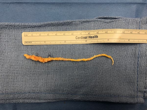 Image of a CABG specimen