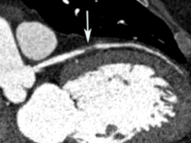Coronary CT demonstrating severe stenosis of the left anterior descending coronary artery (arrow).