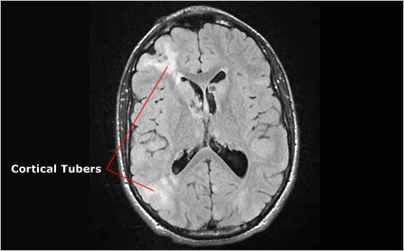 MRI showing tubers
