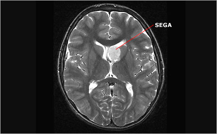 MRI showing SEGA