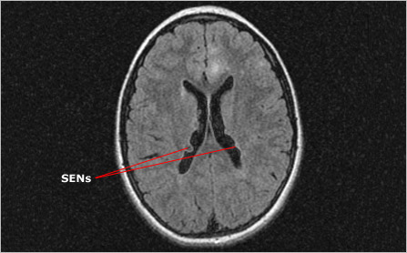 MRI showing SENs