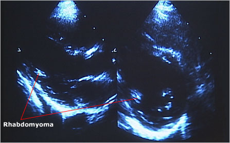 Echocardiogram showing rhabdomyoma