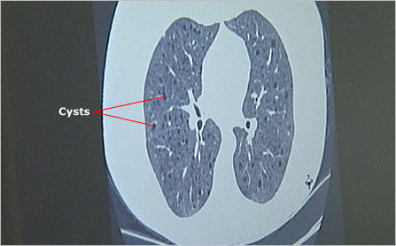 CT scan showing LAM