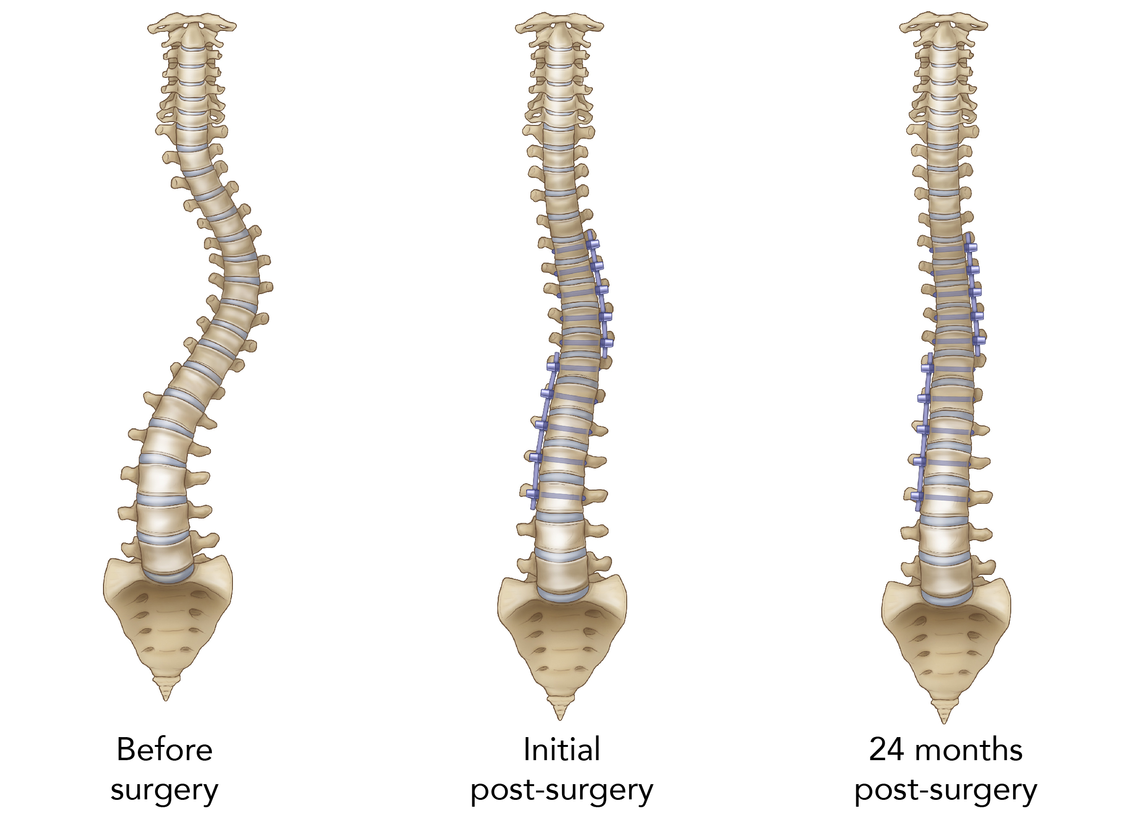 illustration of three spines showing a curved spine, a spine immediately after avt surgery with a tethering device on the spine, and a third spine two years after surgery with the tethering device still intact