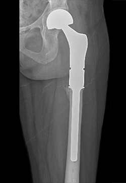 x-ray showing post-op after surgery for chondrosarcoma