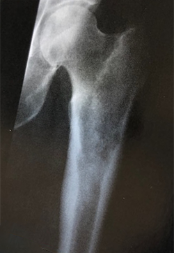x-ray showing chondrosarcoma