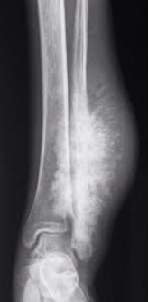 x-ray showing osteosarcoma