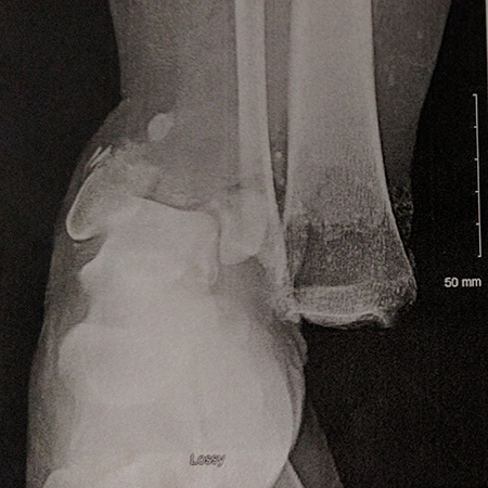 x-ray of Miriam's broken bone after the Spartan Run