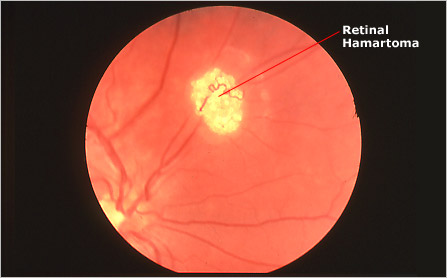 Фотография глазного дна. Montagen retinal platina. Буллезный ретиношизис. Миопическая макулопатия. Montagen retinal platina.