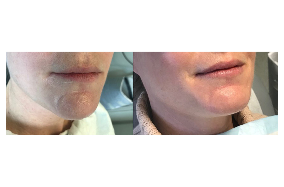 Patient before and after receiving treatment from Dr. Jeremy Goverman for a scar on her lip. Patient before and after receiving treatment from Dr. Jeremy Goverman for a scar on her lip.