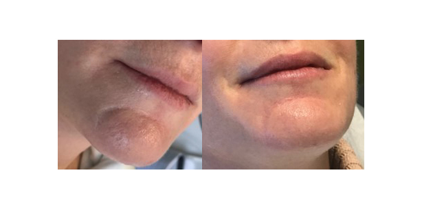 Patient before and after receiving treatment from Dr. Jeremy Goverman for a scar on her lip. Patient before and after receiving treatment from Dr. Jeremy Goverman for a scar on her lip.