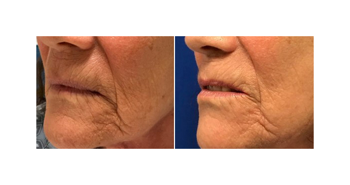 Patient Judith before and after receiving laser treatment with Dr. Jeremy Goverman to treat her sunspots and aging spots. Patient Judith before and after receiving laser treatment with Dr. Jeremy Goverman to treat her sunspots and aging spots.