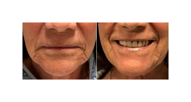Patient Judith before and after receiving laser treatment with Dr. Jeremy Goverman to treat her sunspots and aging spots. Patient Judith before and after receiving laser treatment with Dr. Jeremy Goverman to treat her sunspots and aging spots.