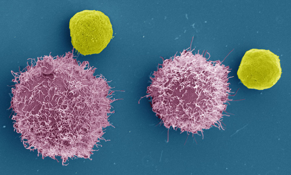 Scanning Electron Micrograph of cancer cells (purple) and white blood cells (yellow). Scanning Electron Micrograph of cancer cells (purple) and white blood cells (yellow).