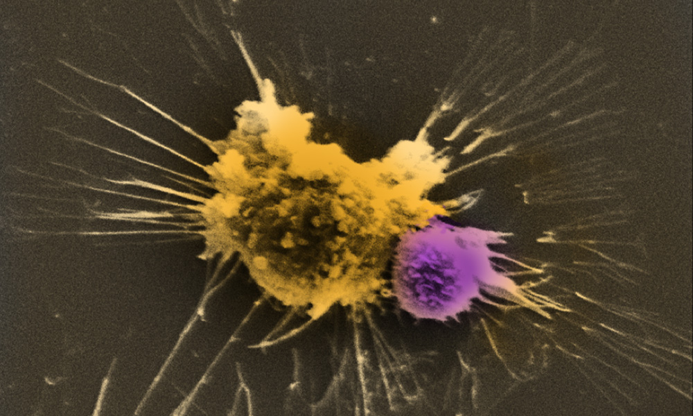 Electron microscope image of CAR T-cell interacting with tumor cell. Image courtesy of Maus lab. Electron microscope image of CAR T-cell interacting with tumor cell. Image courtesy of Maus lab.