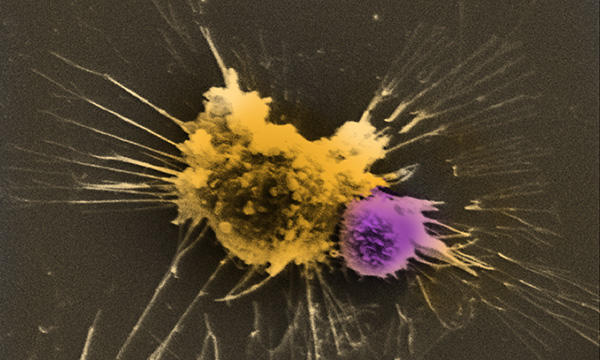 Electron microscope image of CAR T-cell interacting with tumor cell. Image courtesy of Maus lab. Electron microscope image of CAR T-cell interacting with tumor cell. Image courtesy of Maus lab.