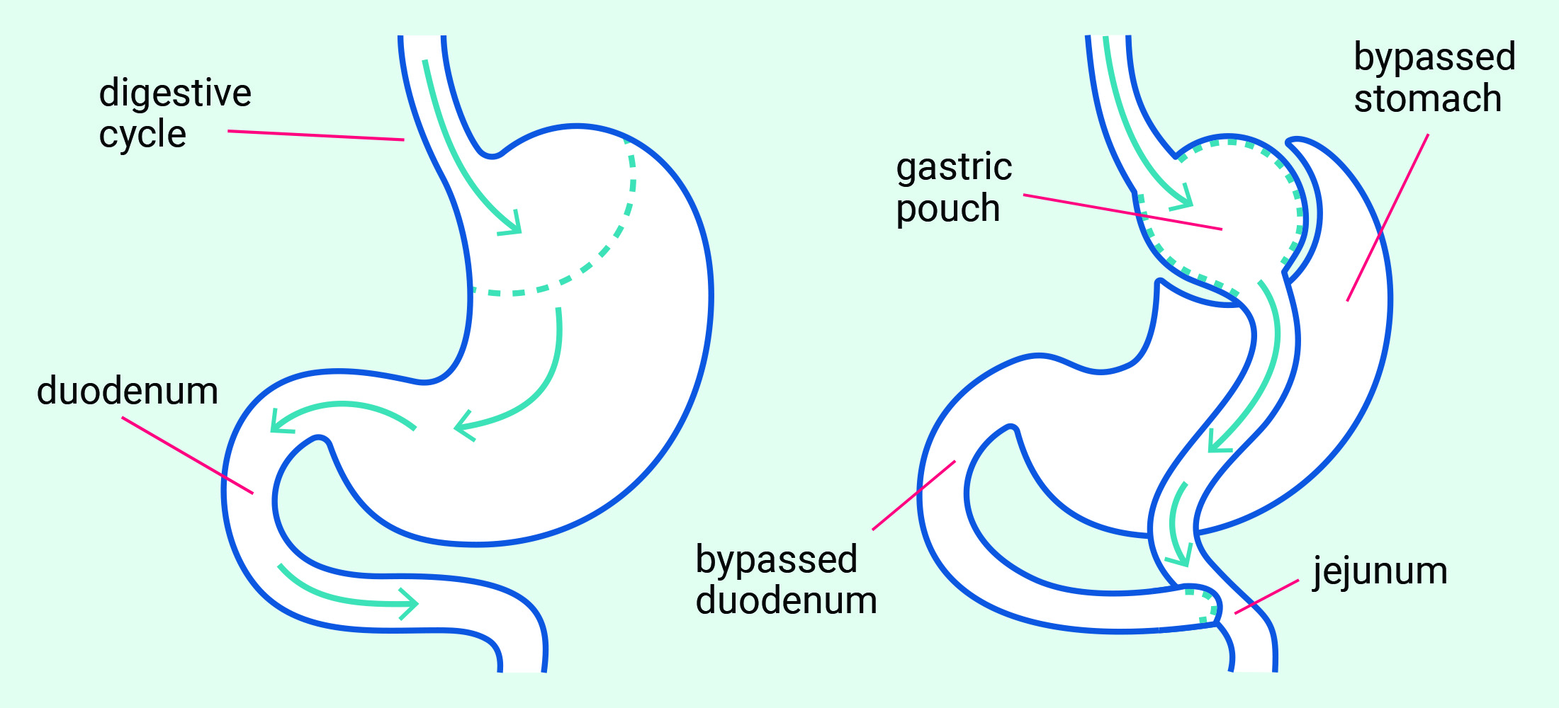 Diagram of the Roux-en-Y gastric bypass procedure