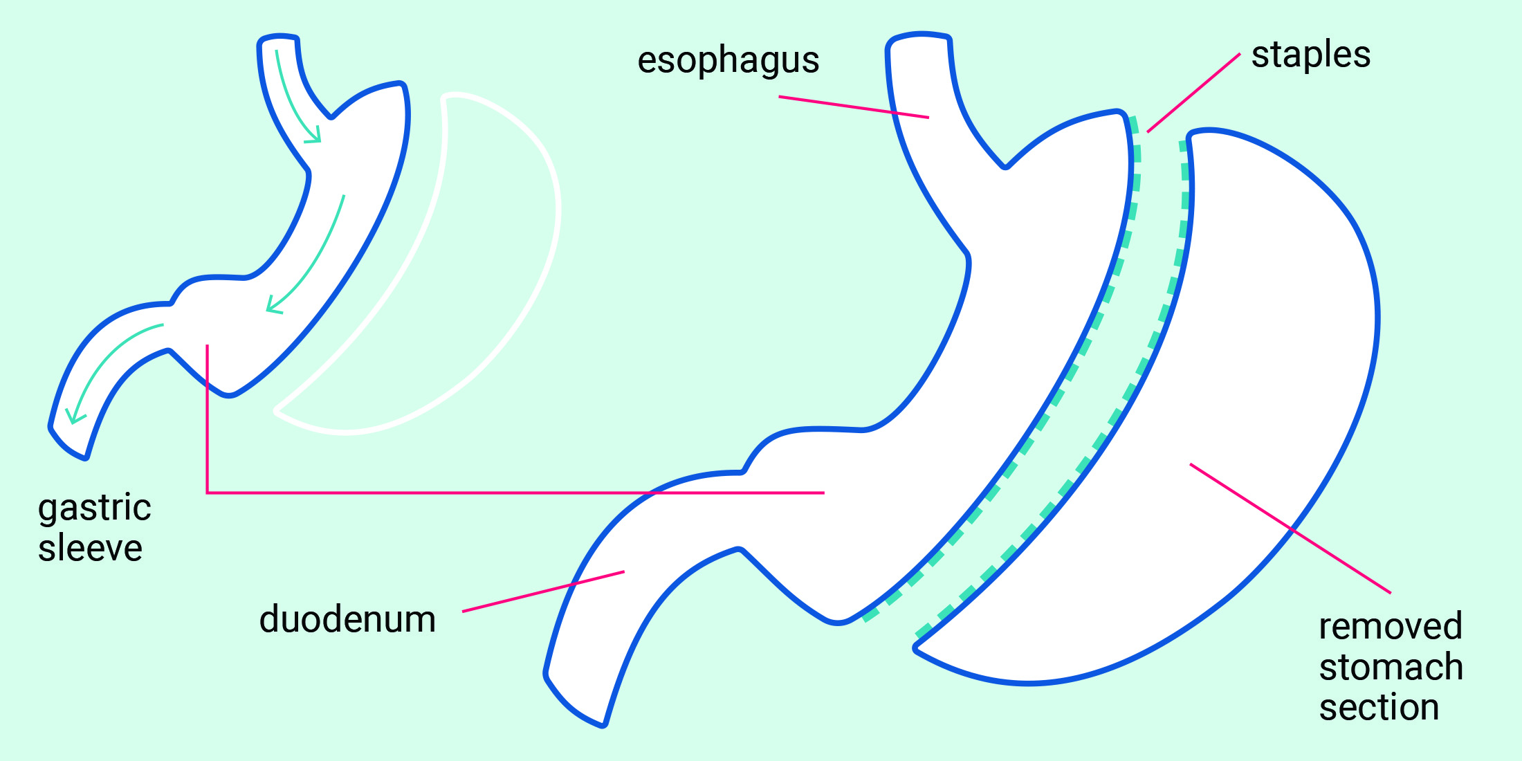 Diagram of the sleeve gastrectomy procedure