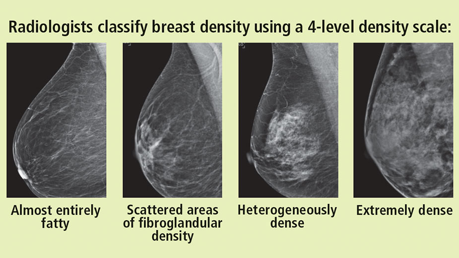Scans of the four levels of breast density: almost entirely fatty, scattered areas of fibroglandular density, heterogeneously dense, and extremely dense. Scans of the four levels of breast density: almost entirely fatty, scattered areas of fibroglandular density, heterogeneously dense, and extremely dense.