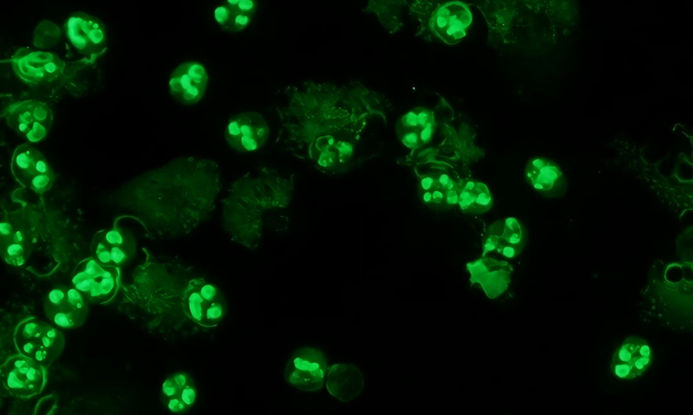 p-ANCA: perinuclear anti-neutrophil cytoplasmic antibodies p-ANCA: perinuclear anti-neutrophil cytoplasmic antibodies