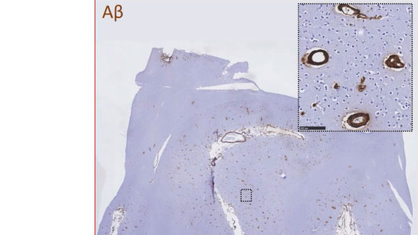 A CAA neuropath A CAA neuropath