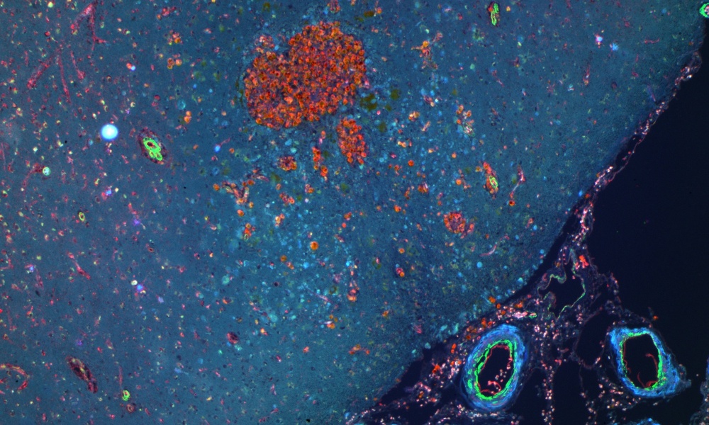 A cortical microbleed with triple fluorescent labeling A cortical microbleed with triple fluorescent labeling