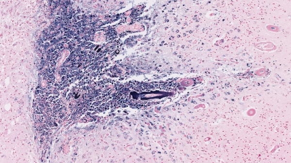A cortical hemorrhage in a CAA case A cortical hemorrhage in a CAA case
