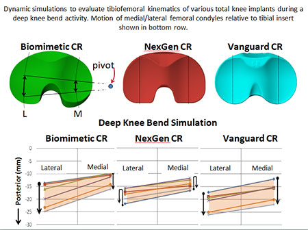 Computational Modeling and FEA of Implant Designs, Figure 2, Harris Orthopaedics Laboratory, Department of Orthopaedic Surgery, Mass General