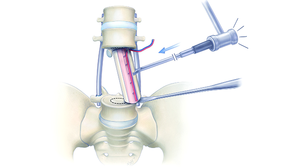 Screenshot from research paper of spine procedure Screenshot from research paper of spine procedure